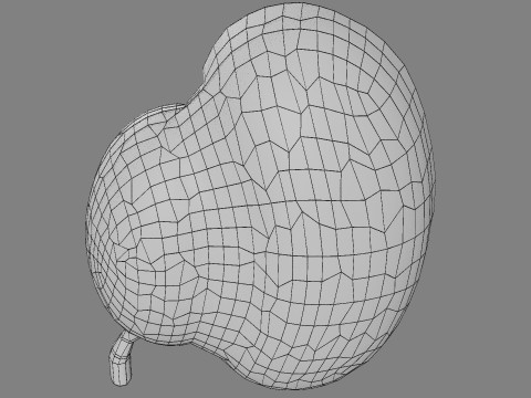 Hydronephrosis marked kidney renal Model 3D