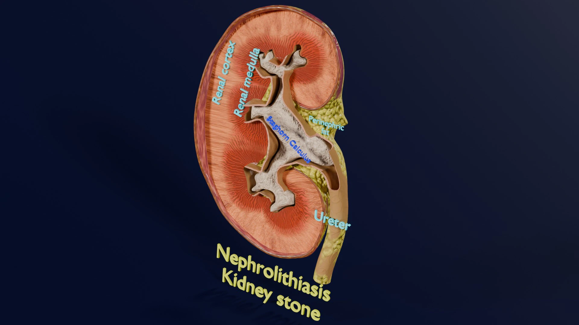 Kidney stone nephrolithiasis Staghorn calculus 3D Model .c4d .max .obj .3ds .fbx .stl .blend 
