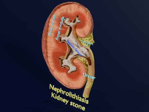 Kidney stone nephrolithiasis Staghorn calculus 3Dモデル