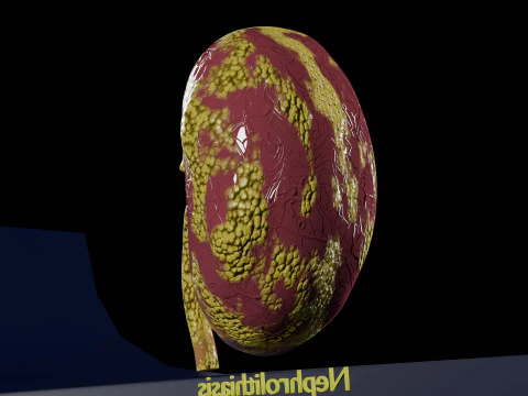 Kidney stone nephrolithiasis Staghorn calculus 3D Model