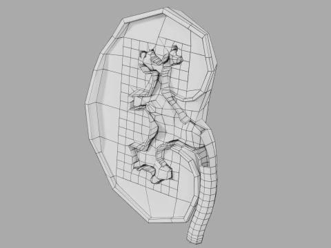 Kidney stone nephrolithiasis Staghorn calculus 3D Model