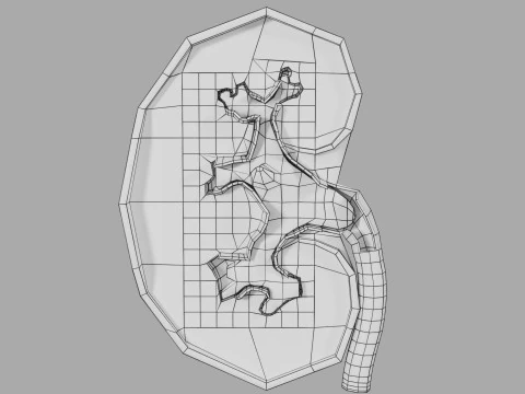 Kidney stone nephrolithiasis Staghorn calculus 3D Model