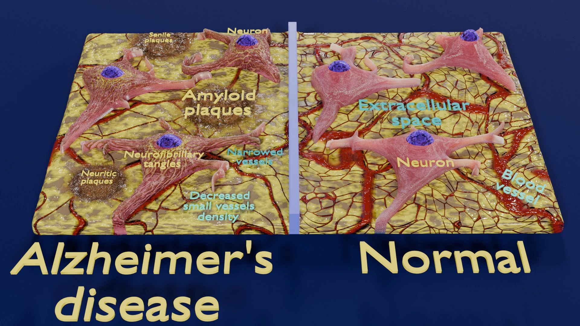 Alzheimer disease microscopy changes brain 3D Model .c4d .max .obj .3ds .fbx .stl .blend 