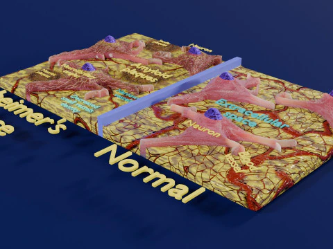 Alzheimer disease microscopy changes brain 3D Model