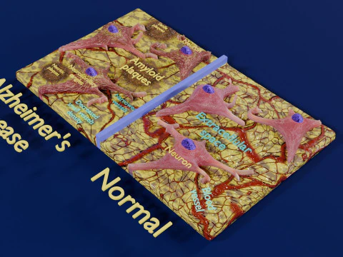 Alzheimer disease microscopy changes brain 3D Model