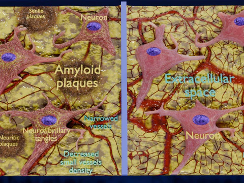 Alzheimer disease microscopy changes brain 3D Model