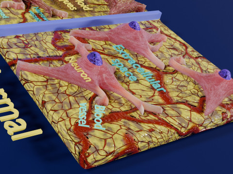 Alzheimer disease microscopy changes brain Modelo 3D