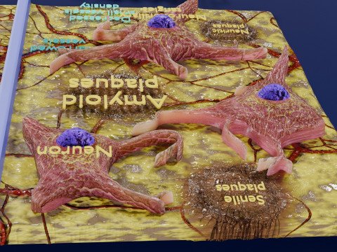 Alzheimer disease microscopy changes brain Modelo 3D