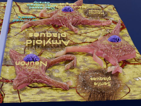 Alzheimer disease microscopy changes brain 3D Model