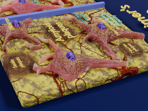 Alzheimer disease microscopy changes brain Modelo 3D
