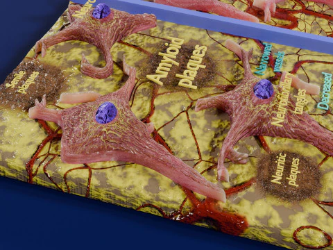 Alzheimer disease microscopy changes brain 3D Model