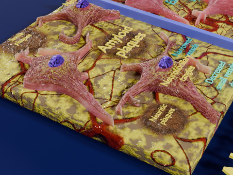 Alzheimer disease microscopy changes brain Modelo 3D