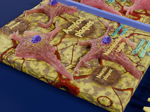 Alzheimer disease microscopy changes brain 3D Model
