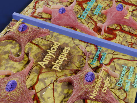Alzheimer disease microscopy changes brain 3D Model