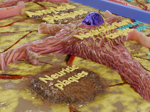Alzheimer disease microscopy changes brain Modelo 3D