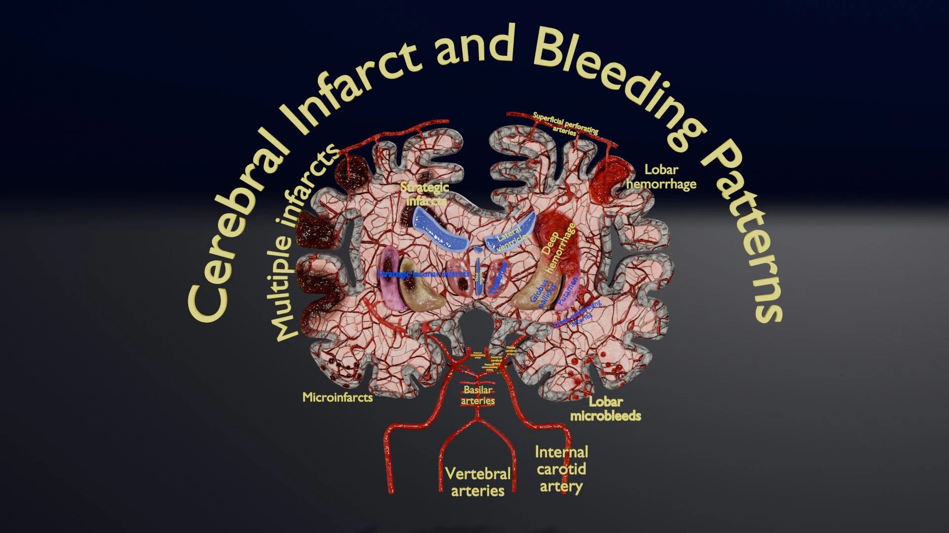 Stroke brain infarct hemorrhage types 3D Model .c4d .max .obj .3ds .fbx .stl .blend 