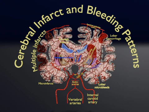 Tipi di emorragia da infarto cerebrale da ictus Modello 3D