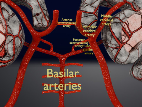 Stroke brain infarct hemorrhage types 3D 모델