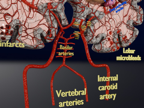 Stroke brain infarct hemorrhage types 3D 모델