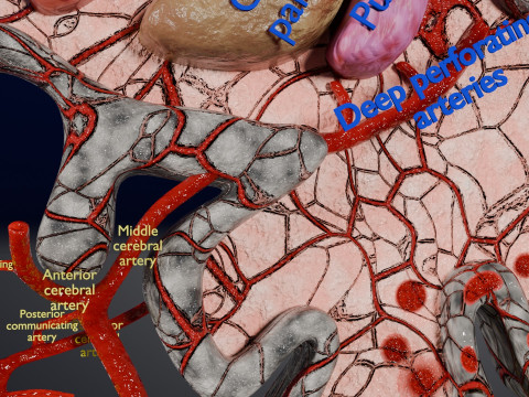 Stroke brain infarct hemorrhage types 3D 모델