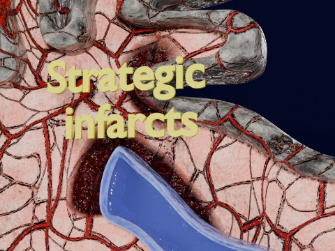 Stroke brain infarct hemorrhage types 3D 모델