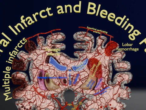 Stroke brain infarct hemorrhage types 3D Model