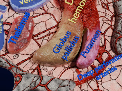 Stroke brain infarct hemorrhage types 3D Model