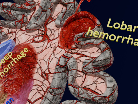 Stroke brain infarct hemorrhage types 3D 모델