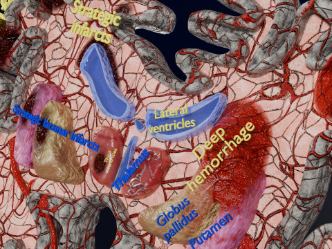 Stroke brain infarct hemorrhage types 3D 모델