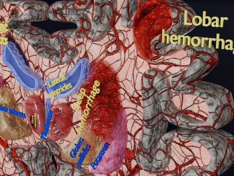 Stroke brain infarct hemorrhage types 3D 모델
