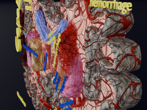 Stroke brain infarct hemorrhage types 3D 모델
