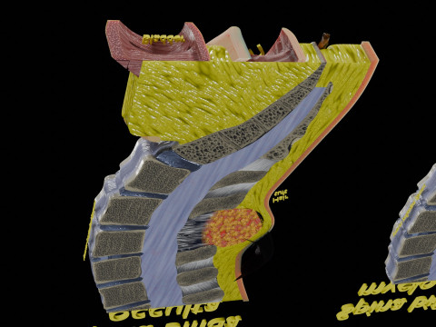Spina bifida Neural Tube Defect 3D Model