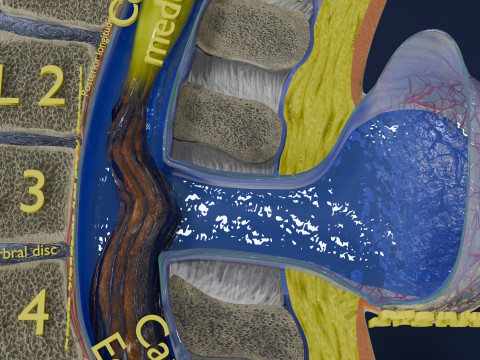 Spina bifida Neural Tube Defect 3D Model