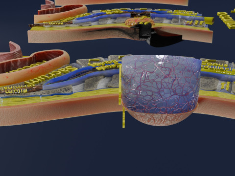 Spina bifida Neural Tube Defect 3D Model