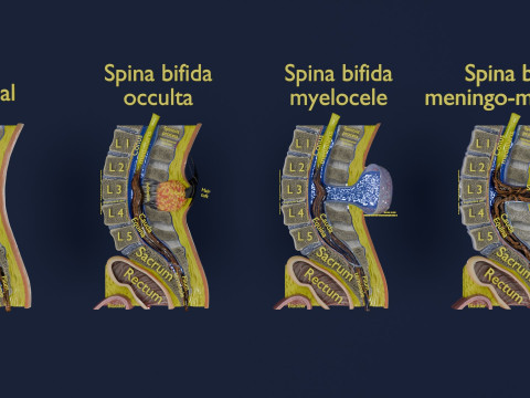 Spina bifida Neural Tube Defect 3D Model