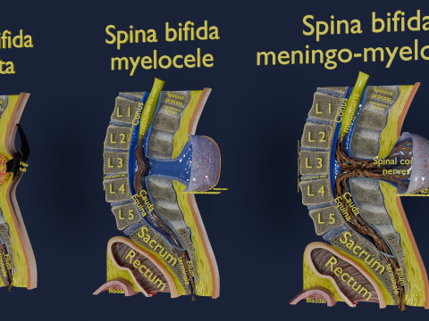 Spina bifida Neural Tube Defect 3D Model