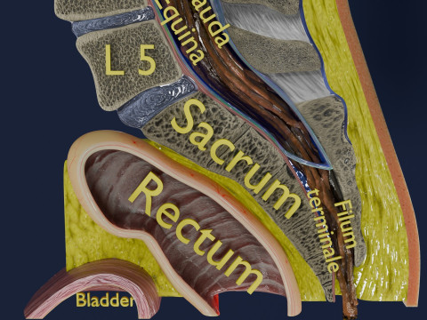 Spina bifida Neural Tube Defect 3D Model