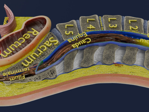 Spina bifida Neural Tube Defect 3D Model