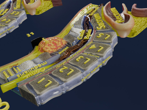 Spina bifida Neural Tube Defect 3D Model