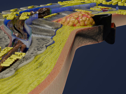 Spina bifida Neural Tube Defect 3D Model