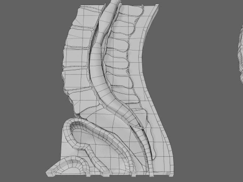 Spina bifida Neural Tube Defect 3D Model