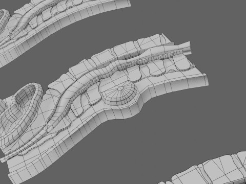 Spina bifida Neural Tube Defect 3D Model