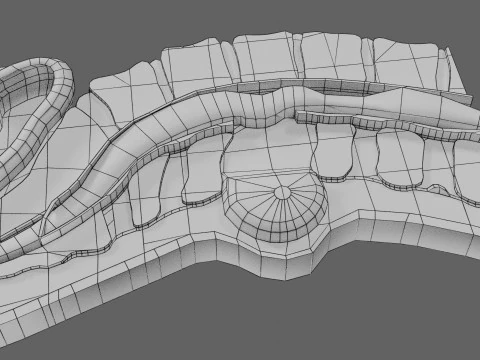 Spina bifida Neural Tube Defect 3D Model