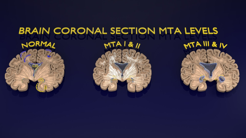 Hippocampus atrophy levels MTA 1-4 Model 3D .c4d .max .obj .3ds .fbx .stl .blend