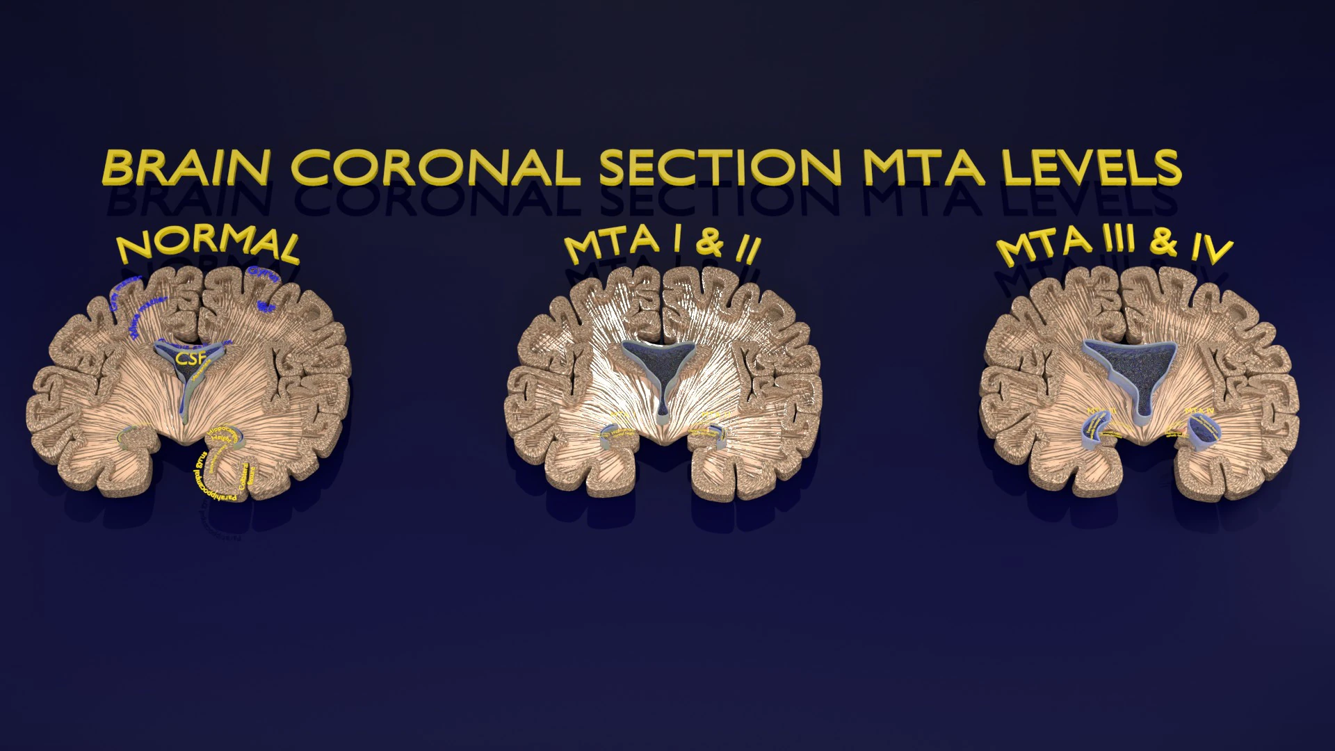 Hippocampus atrophy levels MTA 1-4 3D Model .c4d .max .obj .3ds .fbx .stl .blend 