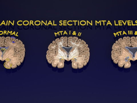 Hippocampus atrophy levels MTA 1-4 3D Model