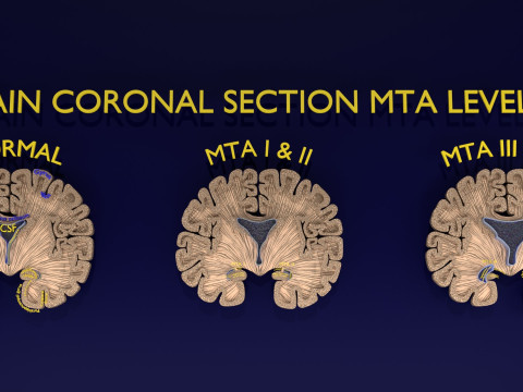 Hippocampus atrophy levels MTA 1-4 Model 3D