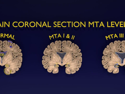 Hippocampus atrophy levels MTA 1-4 3D Model