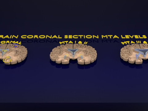 Hippocampus atrophy levels MTA 1-4 Model 3D