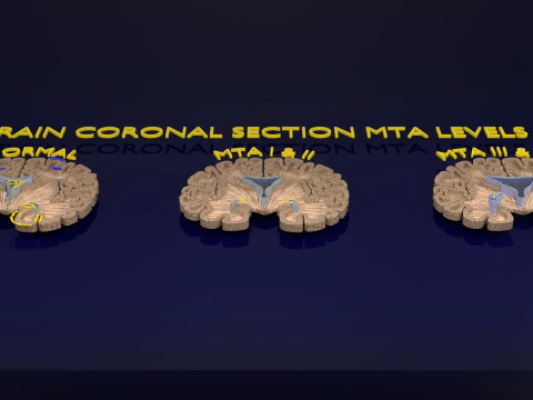 Hippocampus atrophy levels MTA 1-4 3D Model